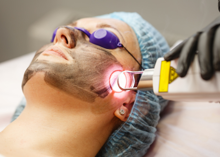 CO2 Laser Treatment: Advanced Solution for Acne Scars, Wrinkles & Skin Resurfacing